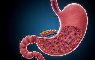 Az endoszkópia jelentősége a reflux tüneteinek kezelésében