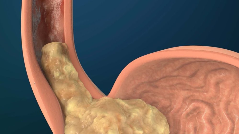 Hogyan enyhíthetjük az éjszakai reflux tüneteit?